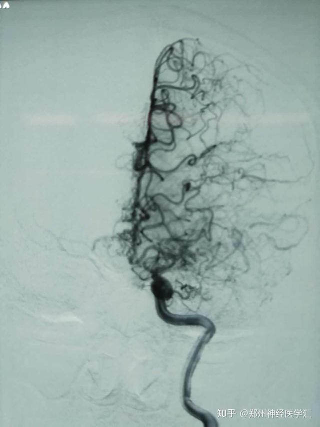 因脑血管造影时与吸烟时吐出的烟雾病非常相似,故形象的称之为烟雾病