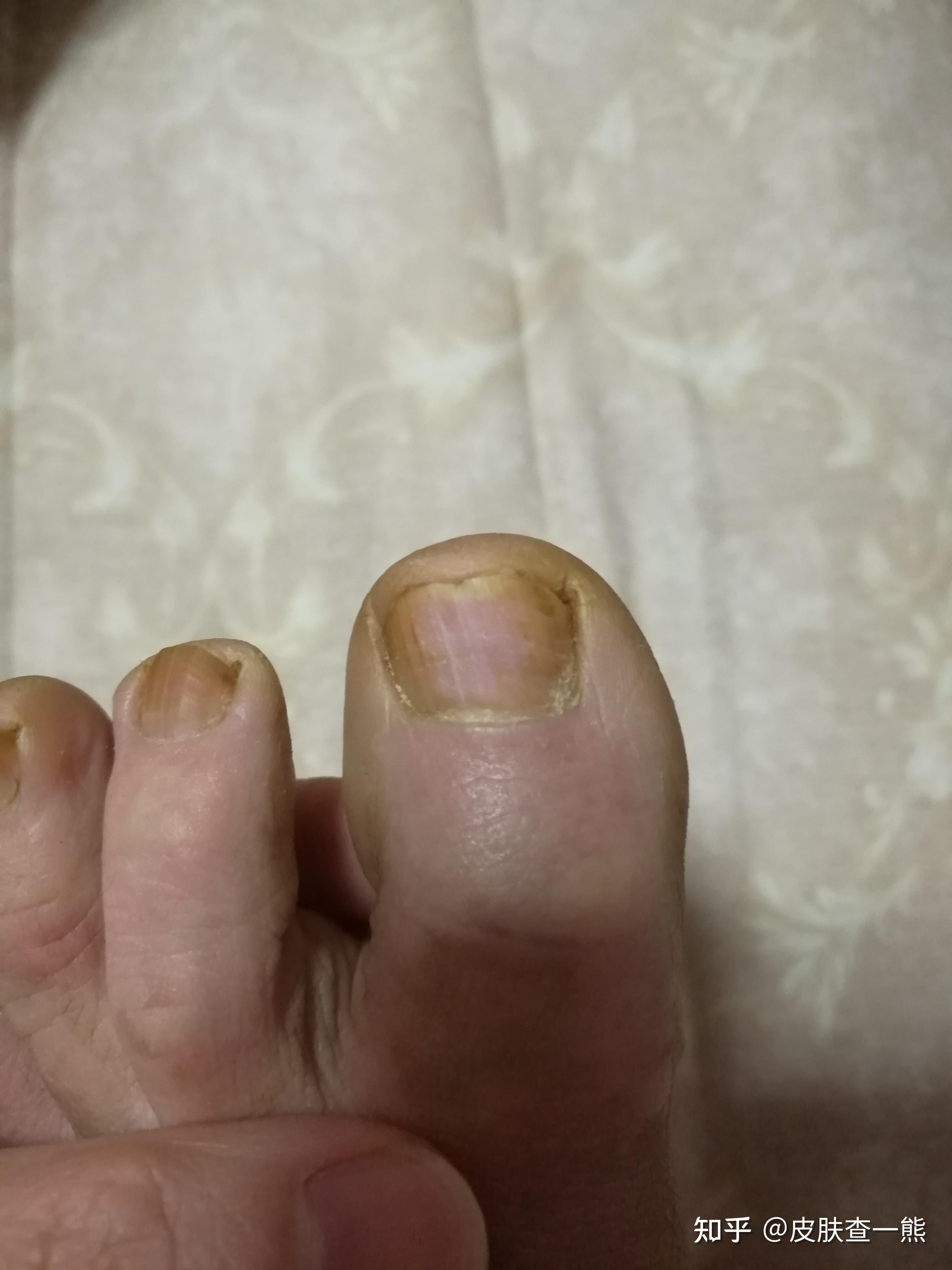 脚大拇指灰指甲初期怎么治疗,指甲盖变色发黑? - 知乎