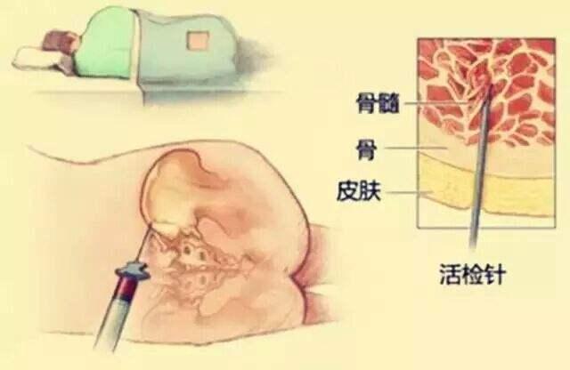 骨穿 腰穿 傻傻分不清楚 知乎