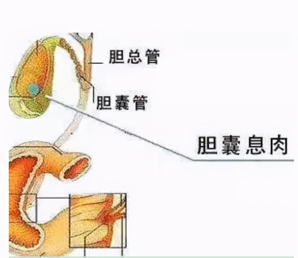 胆囊息肉在哪个位置图片