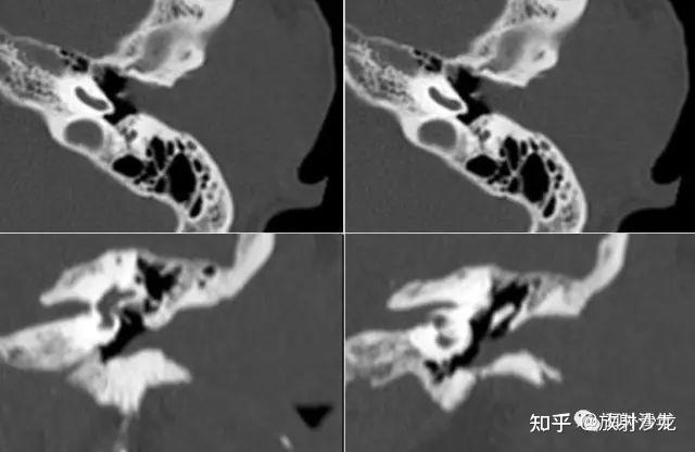 常见异常的颞骨CT总结 - 知乎