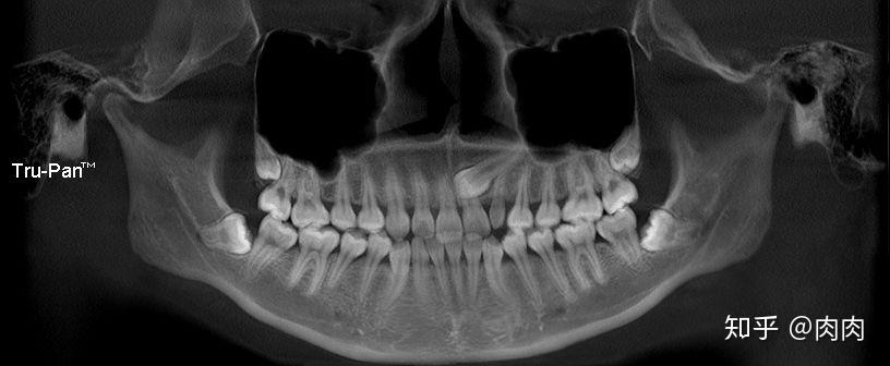 智齿和上颌窦ct图图片