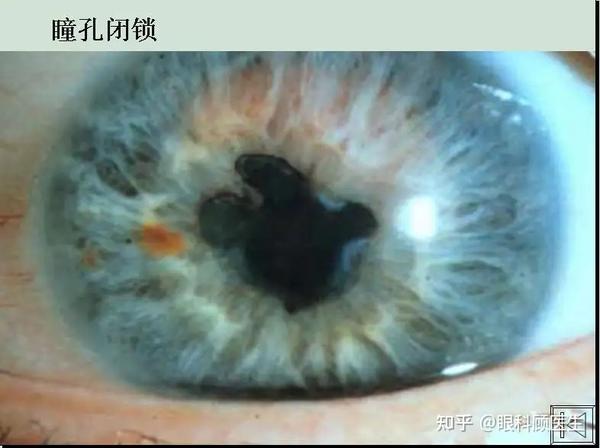 前葡萄膜炎的临床表现有哪些？ 知乎 