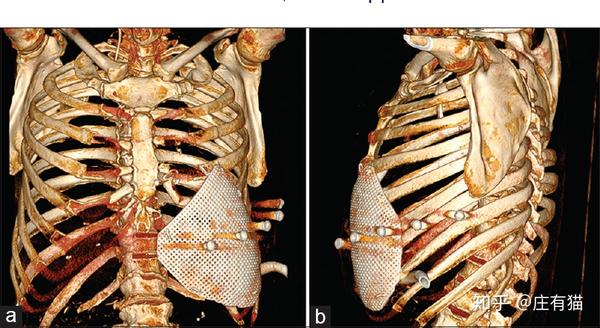 肋骨術後的 ct 三維重建