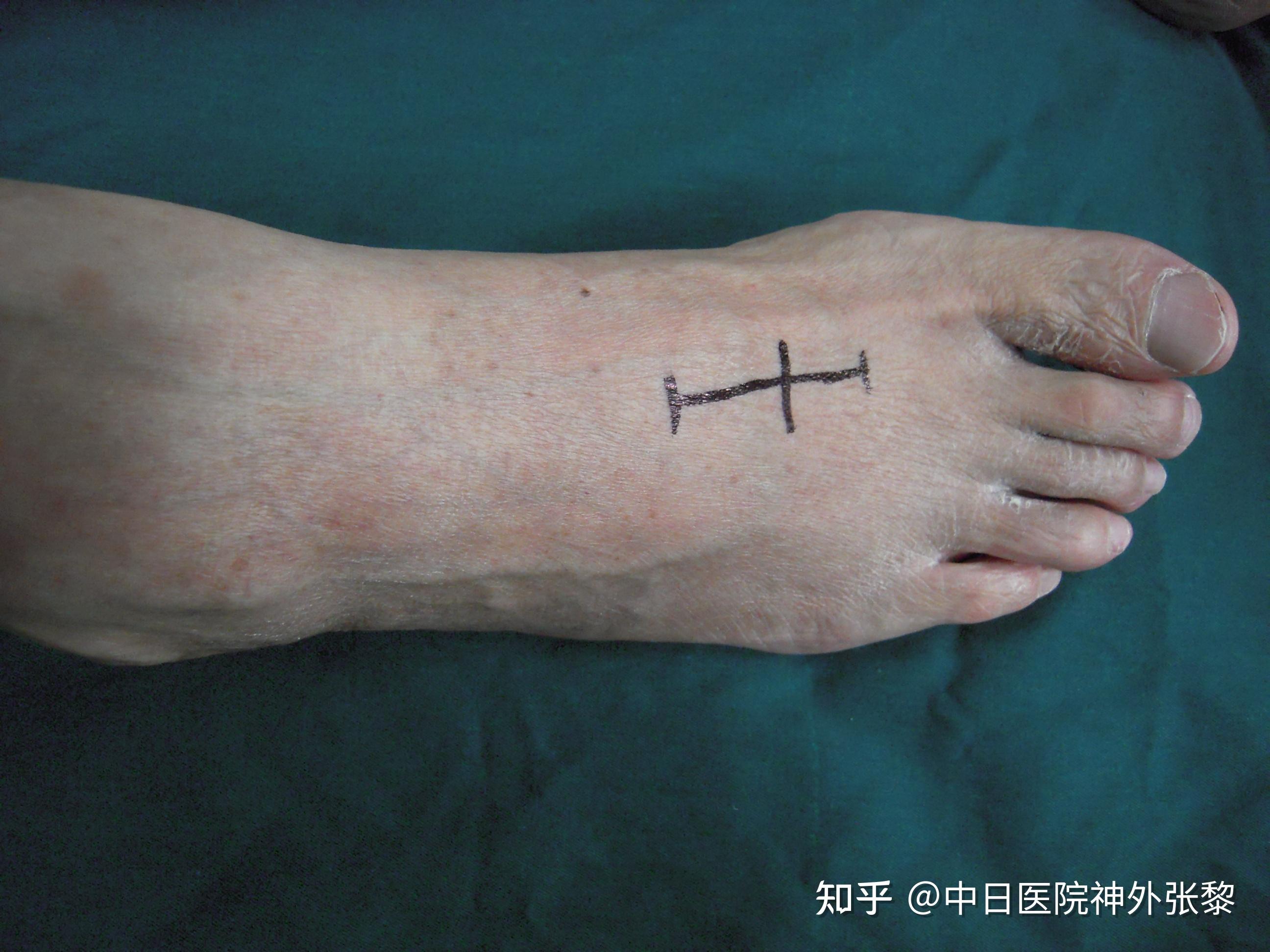 腓总神经卡压综合征有哪些症状?