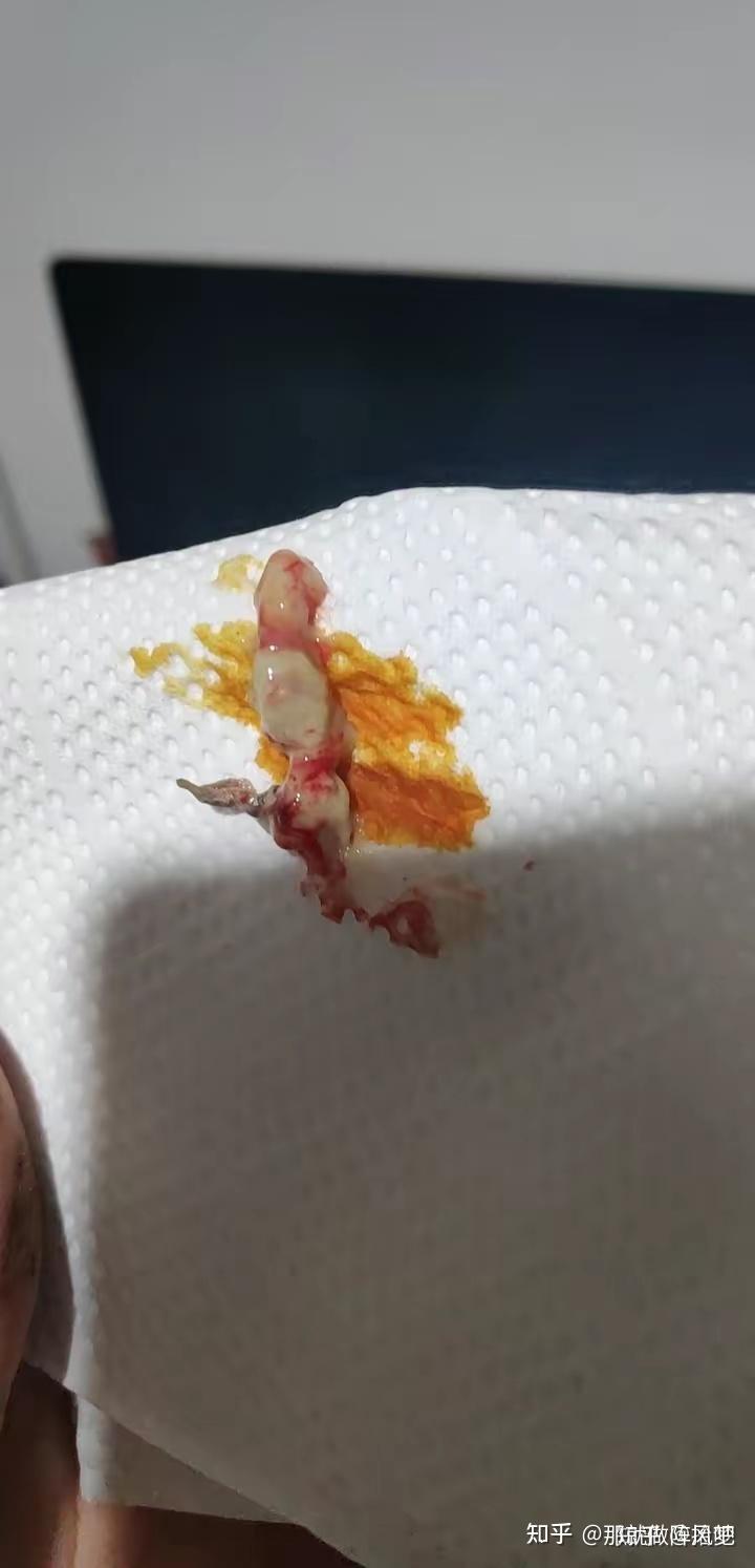 屁股上长个火疖子是什么感受