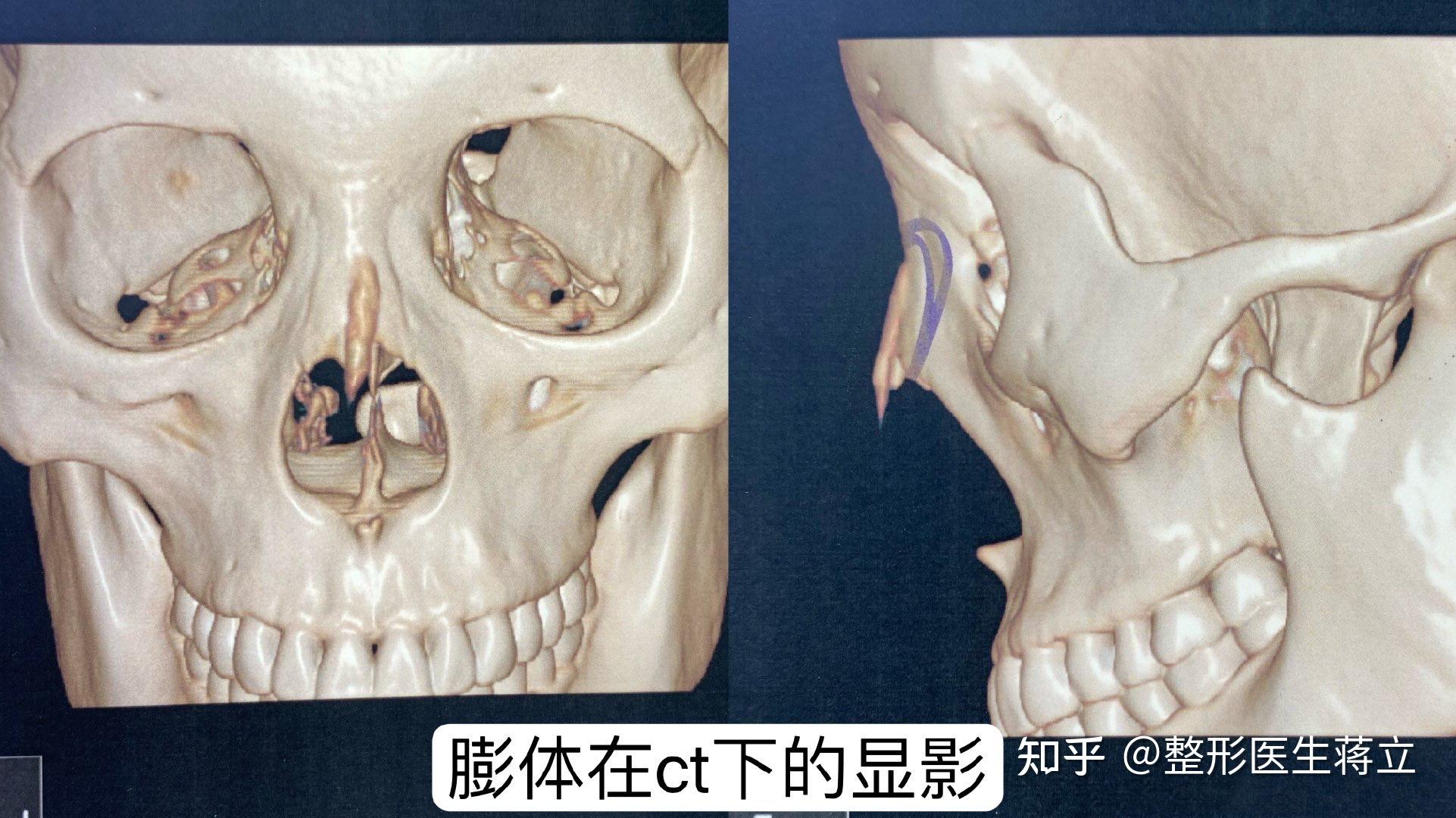 全肋鼻修復鼻尖圓鈍尤其鼻尖上區兩側寬圓鼻頭夾捏