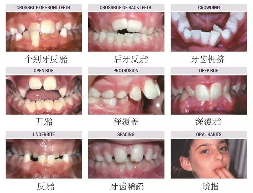 牙齒矯正一定要拔牙嗎