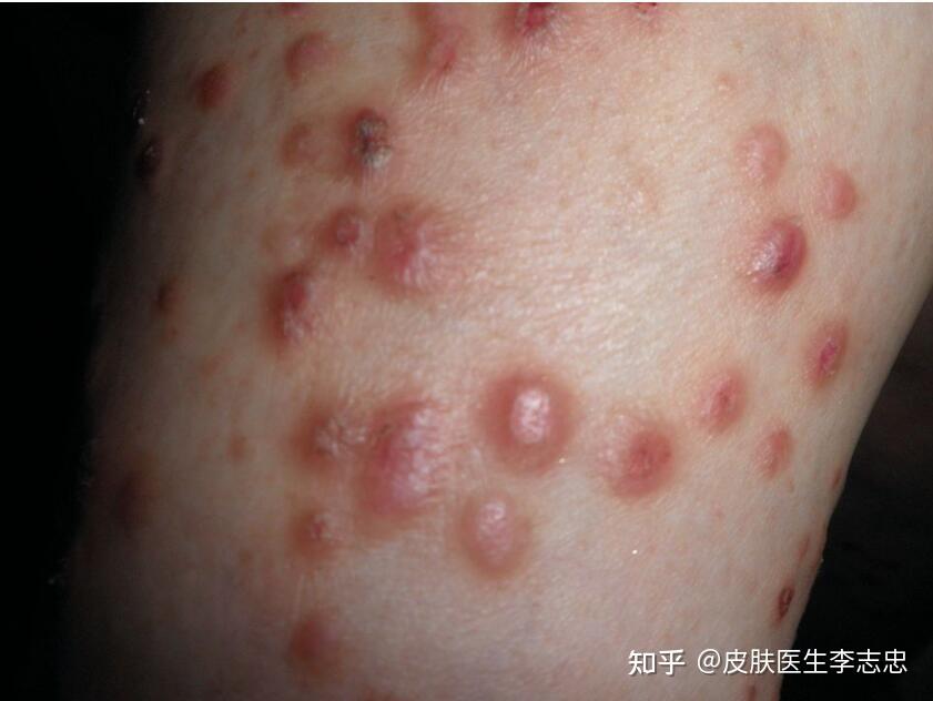 中医如何治疗结节性痒疹？名方四物消风散可治！ - 知乎