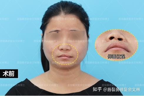 你能看得出她曾经是一名兔唇患者吗? - 知乎