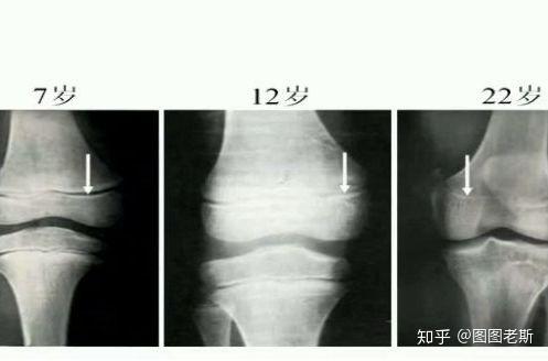 23歲還能長嗎怎麼看骨骺線是否閉合關於長高圖圖有話說