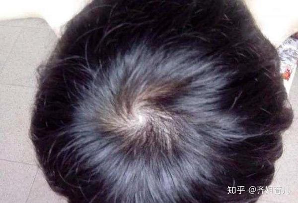 “一旋好,二旋坏?”孩子头顶有两个旋,背后到底有什么含义 - 知乎
