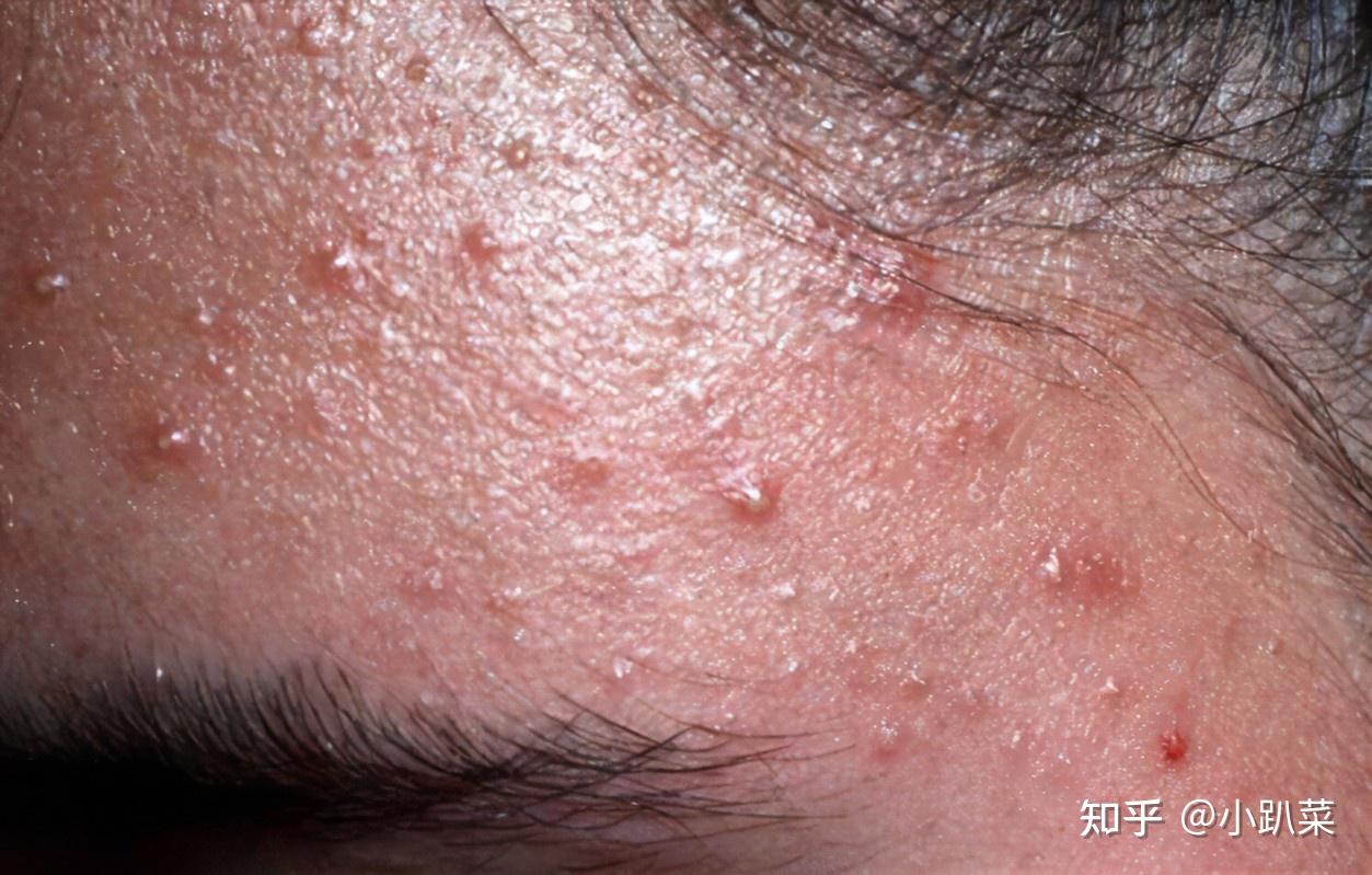 皮肤及软组织感染诊治大全（毛囊炎、疖, 痈、蜂窝织炎、丹毒等）_治疗