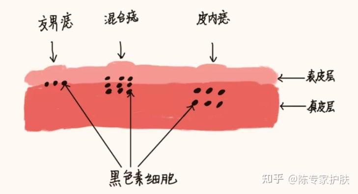 常见“痣”类型 - 知乎