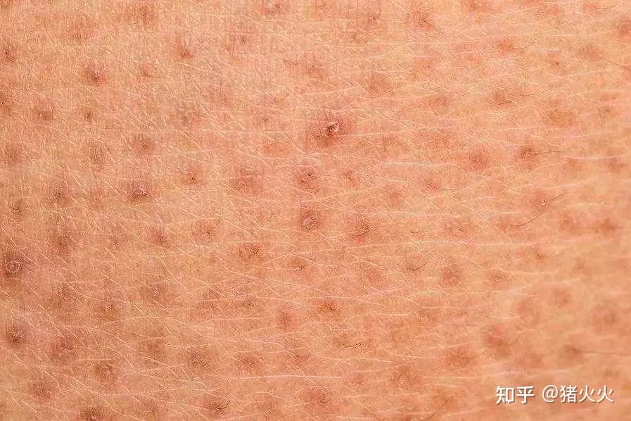 鸡皮肤怎么淡化黑色素推荐的简单介绍