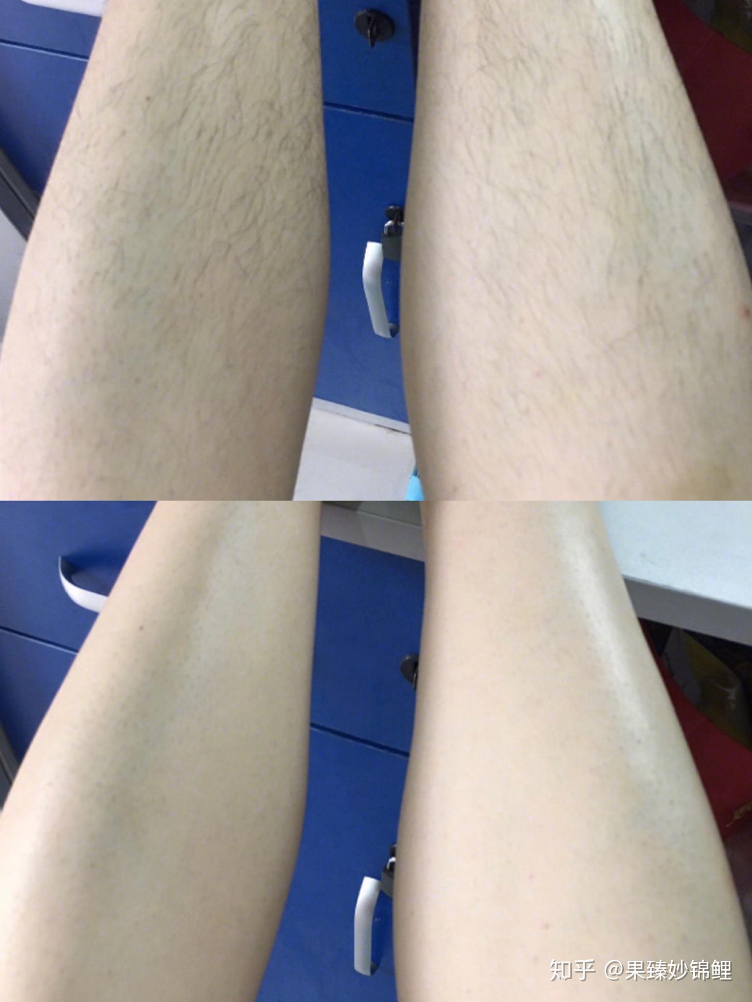 体毛比较多的女生,该咋整呀?