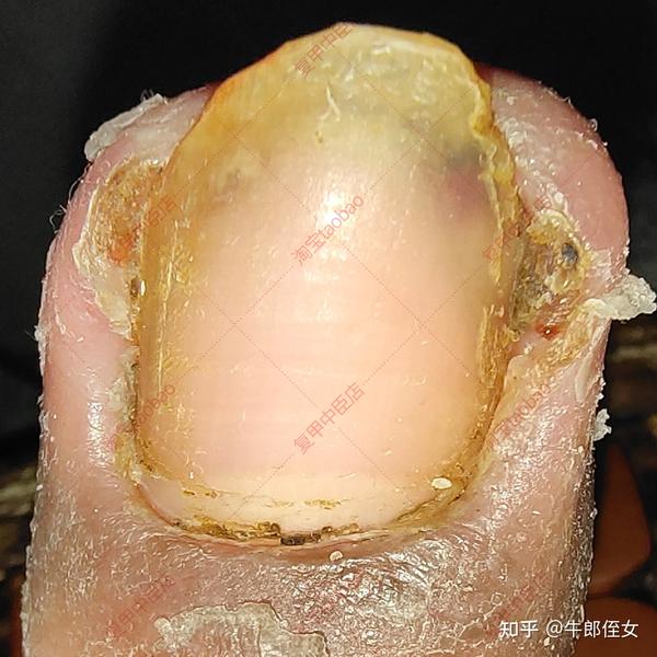 甲沟炎一直流脓怎么办？中药干敷甲沟就能解决