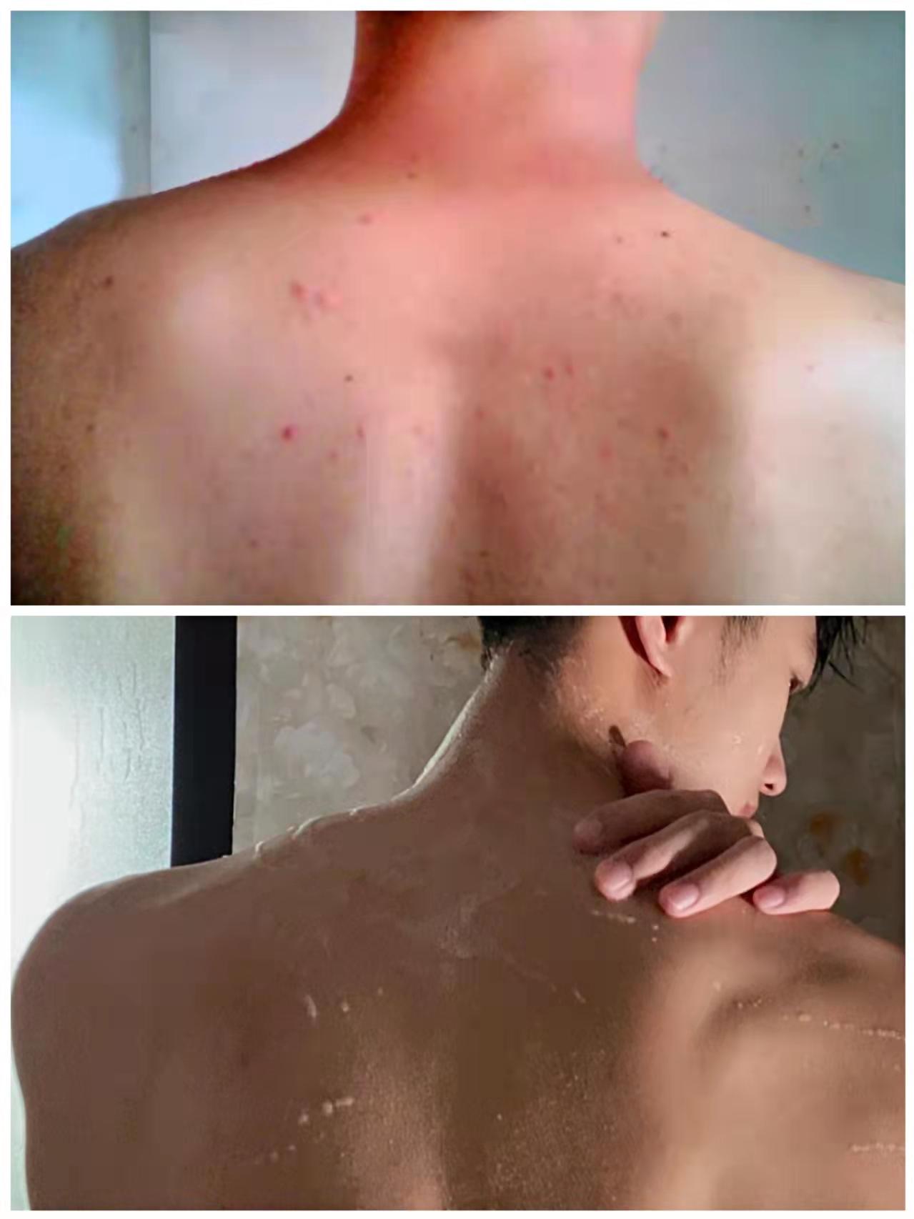 从青春期开始,我一直不知道为什么身上会起这么多痘痘,平时不光痒,还