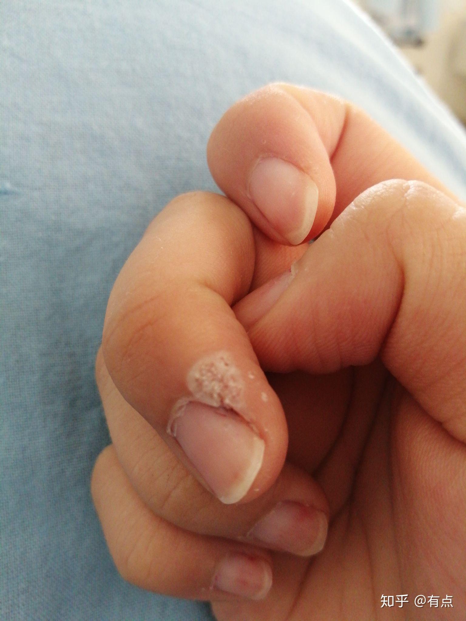 手指长瘊子症状图片图片