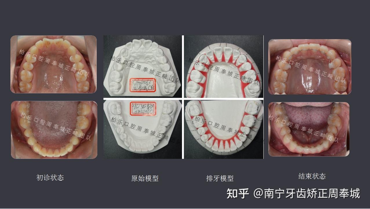 经过治疗,小姐姐终于可以放开大笑,做一个漂亮mm牙齿排齐,上前牙压低
