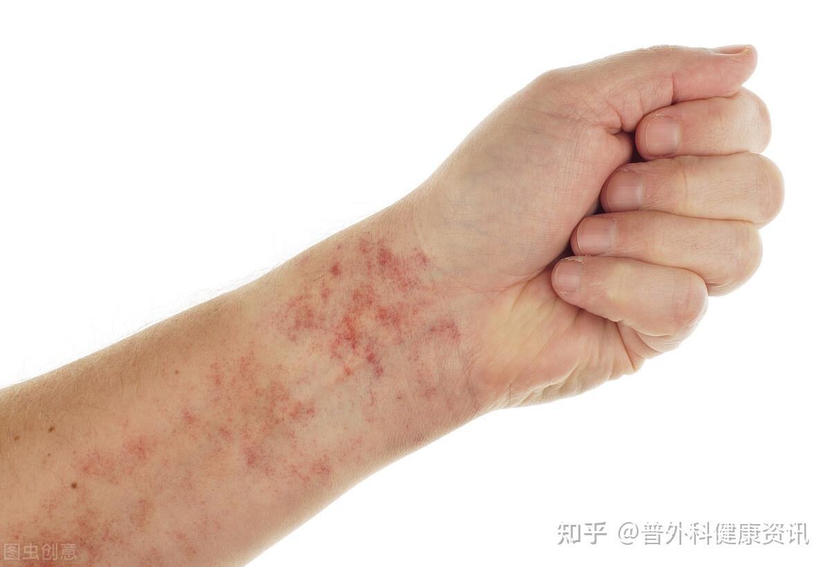 手指血管炎怎么恢复?3招手指痊愈 - 知乎