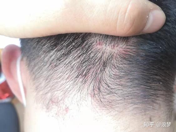 头皮痒什么问题?12大护理头皮的必看内容错过后悔! - 知乎