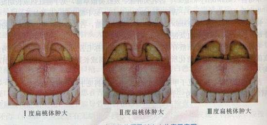 下面有请扁桃体发炎扁桃体老发炎切不切