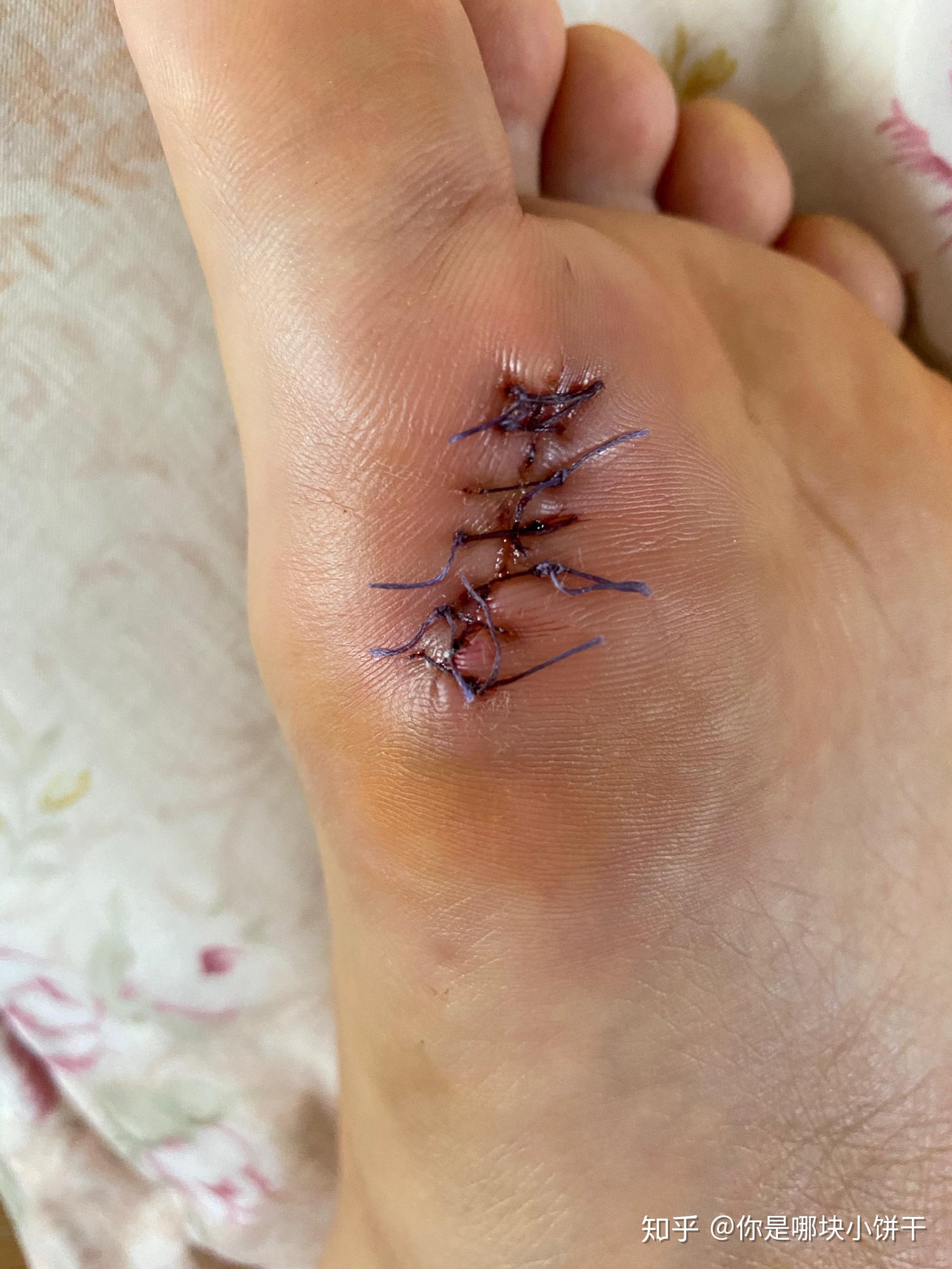 手术切脚底痣是怎么样的体验? - 知乎