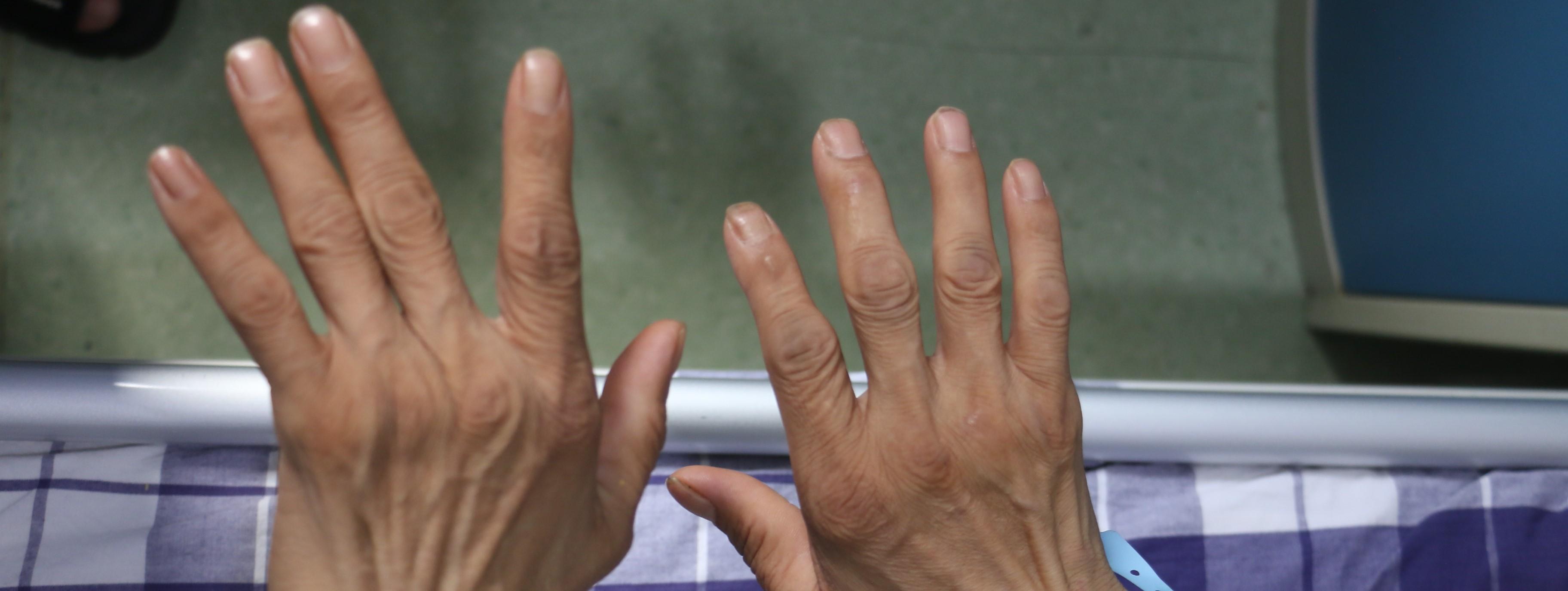 4个孩子的父亲得了类风湿,手指关节已经变形,若仍不规范治疗,这个家又