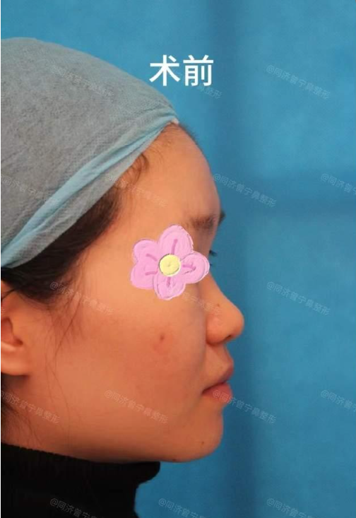 【鼻整形案例5】塌鼻梁姑娘变美记,挺翘鼻梁不是梦! - 知乎