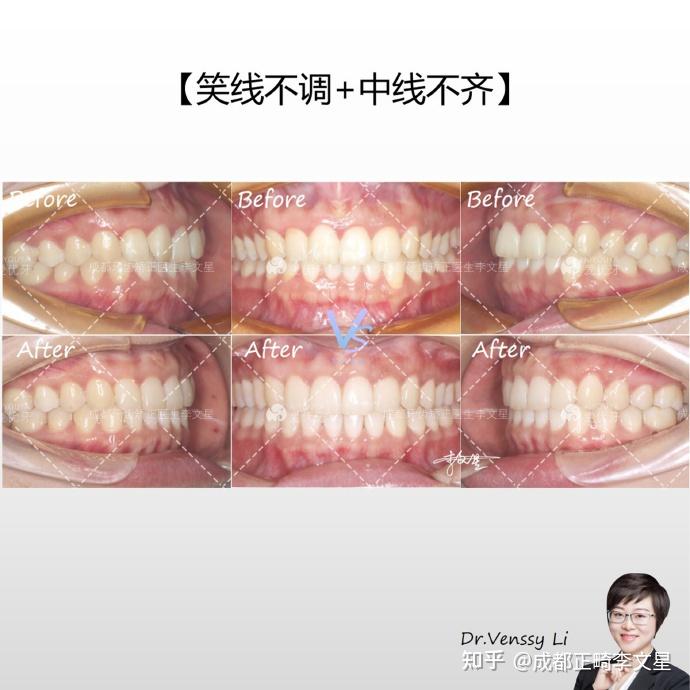 成都牙齿矫正丨微笑美学矫正案例分享 - 知乎