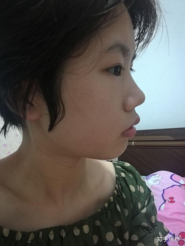 龅牙凸嘴怎么改善侧脸?