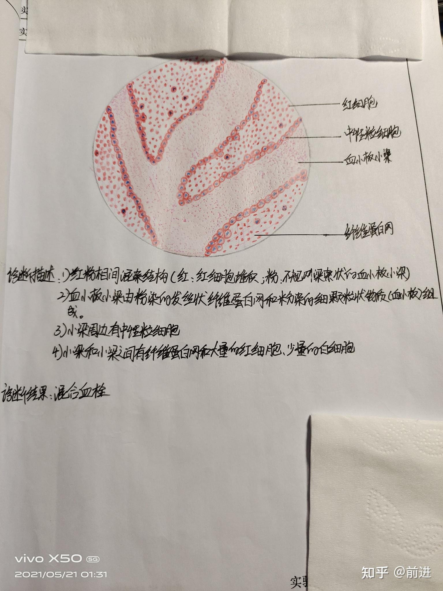 混合血栓红蓝手绘图图片