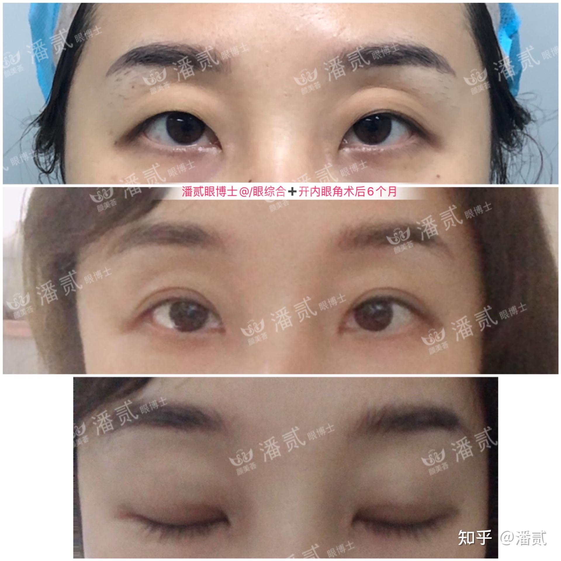 凸眼睛者：眼球突出高于眉骨、上睑凹陷和（或）多层，双眼皮设计为何不宜过宽？ - 知乎