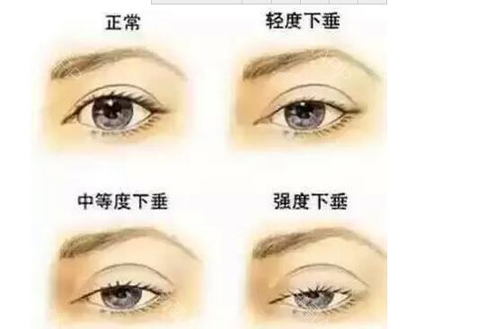 内双想做好看的双眼皮,要怎么选择术式? - 知乎
