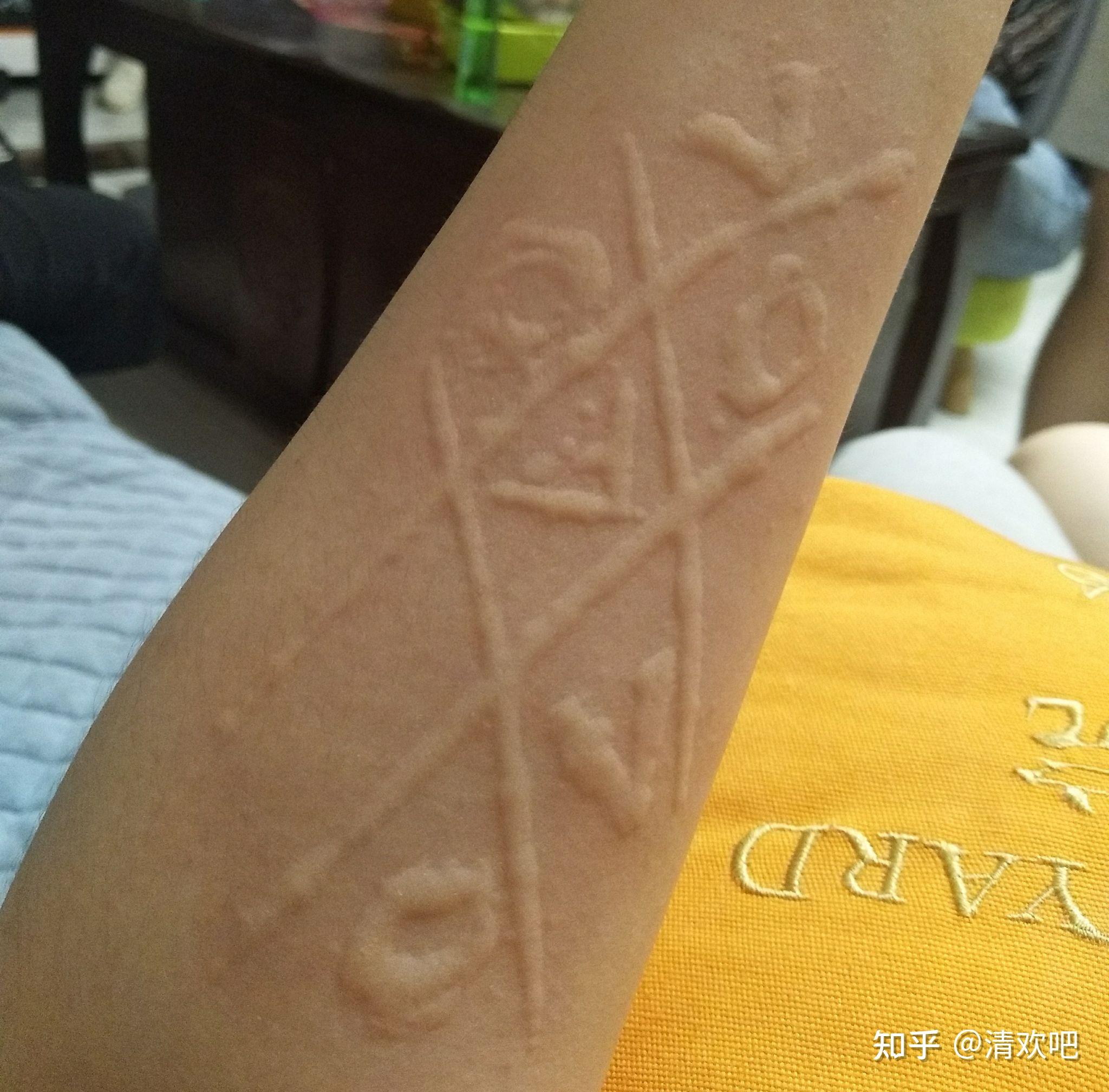 人工性荨麻疹皮肤划痕症能否治愈有无自愈可能