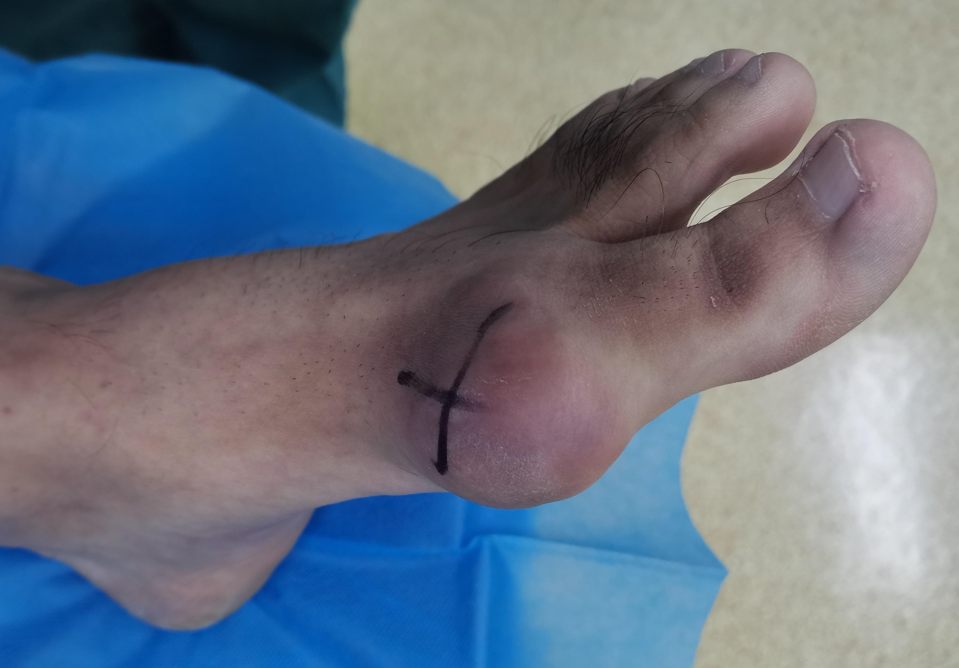 当出现痛风石后,血液中升高的尿酸还会不断析出,沉积在痛风石的表面