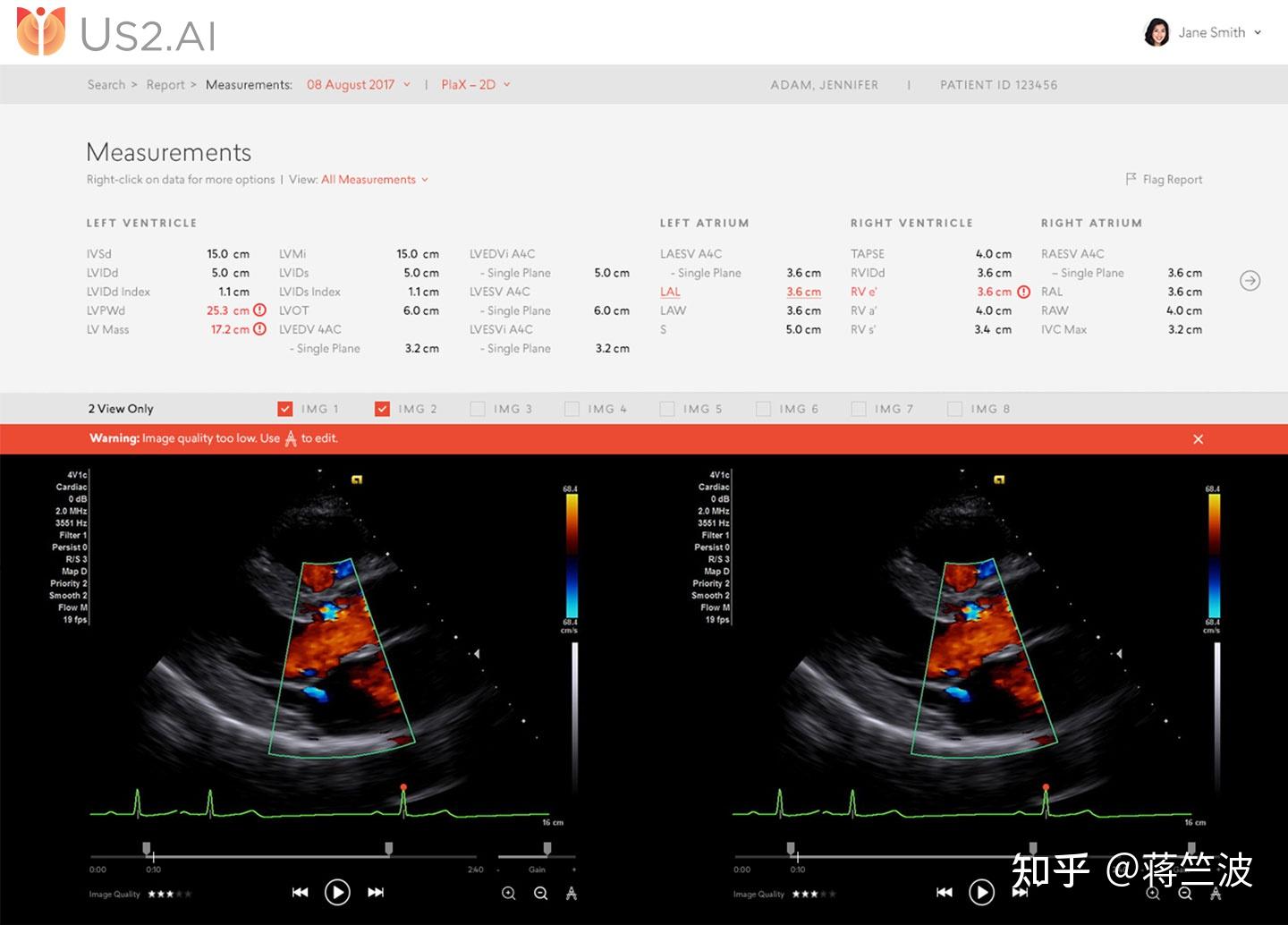 fda批准首个ai全自动心脏超声解决方案来测量2d和多普勒超声心动图