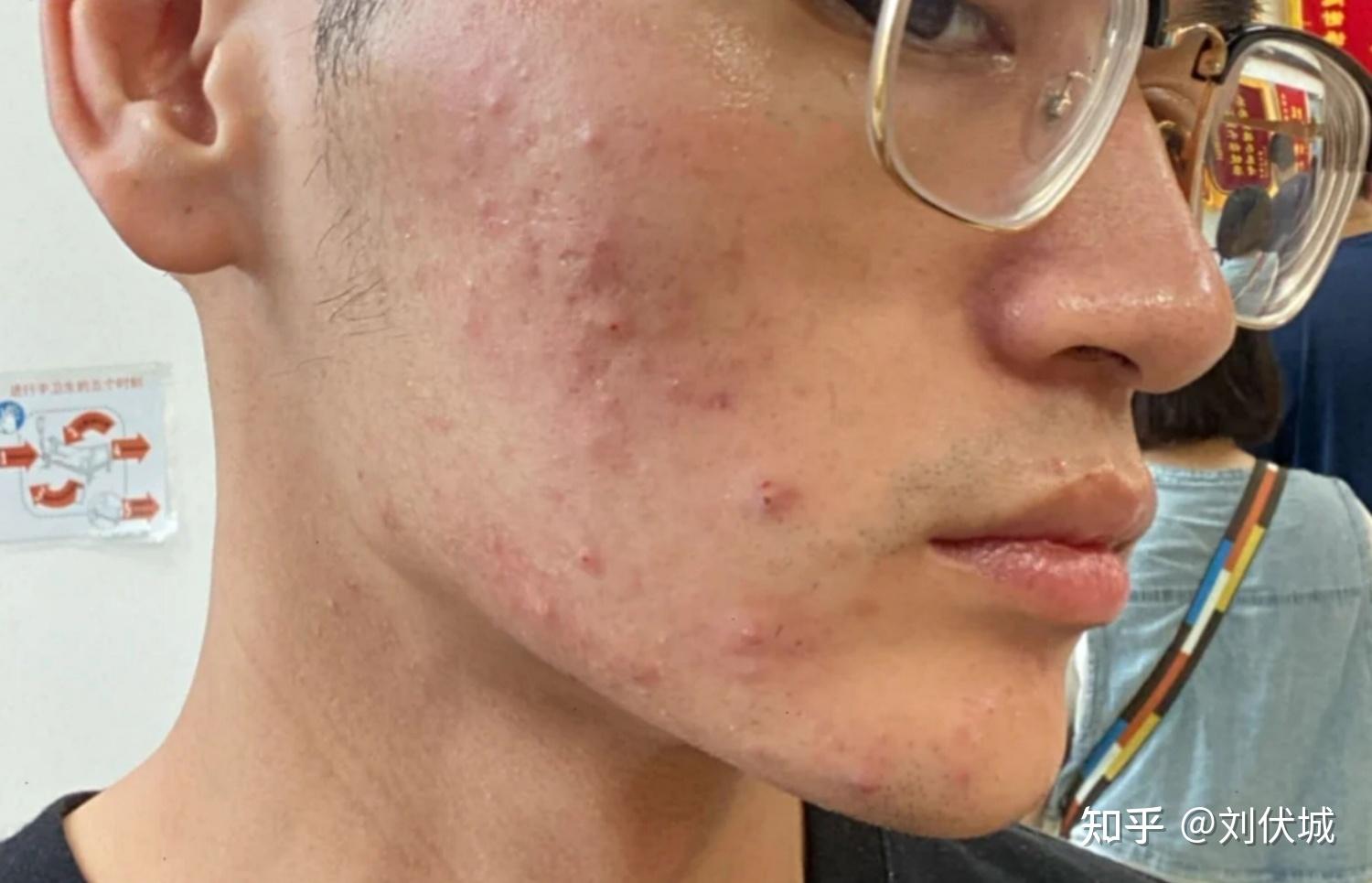 男生油性皮肤用什么护肤品