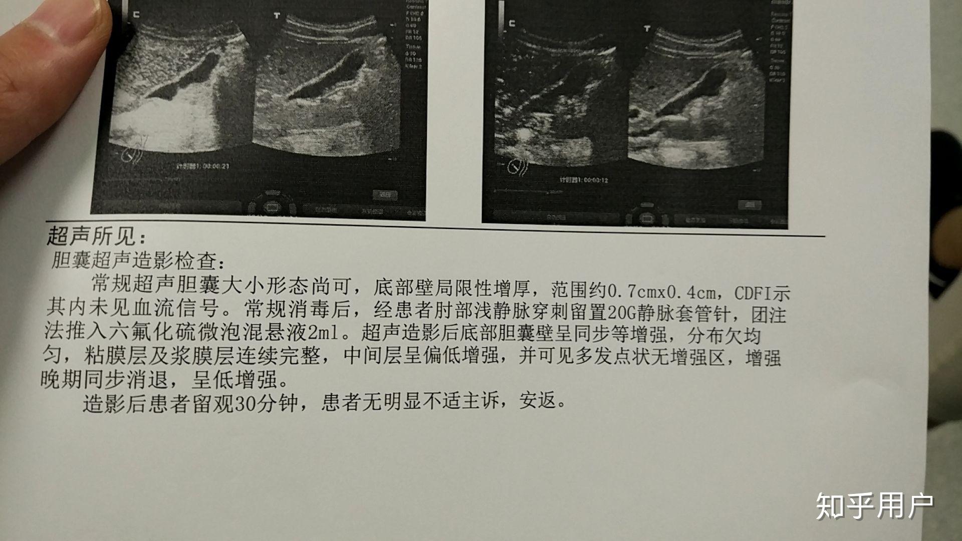 问题局限型胆囊腺肌增生症需要切除胆囊吗?