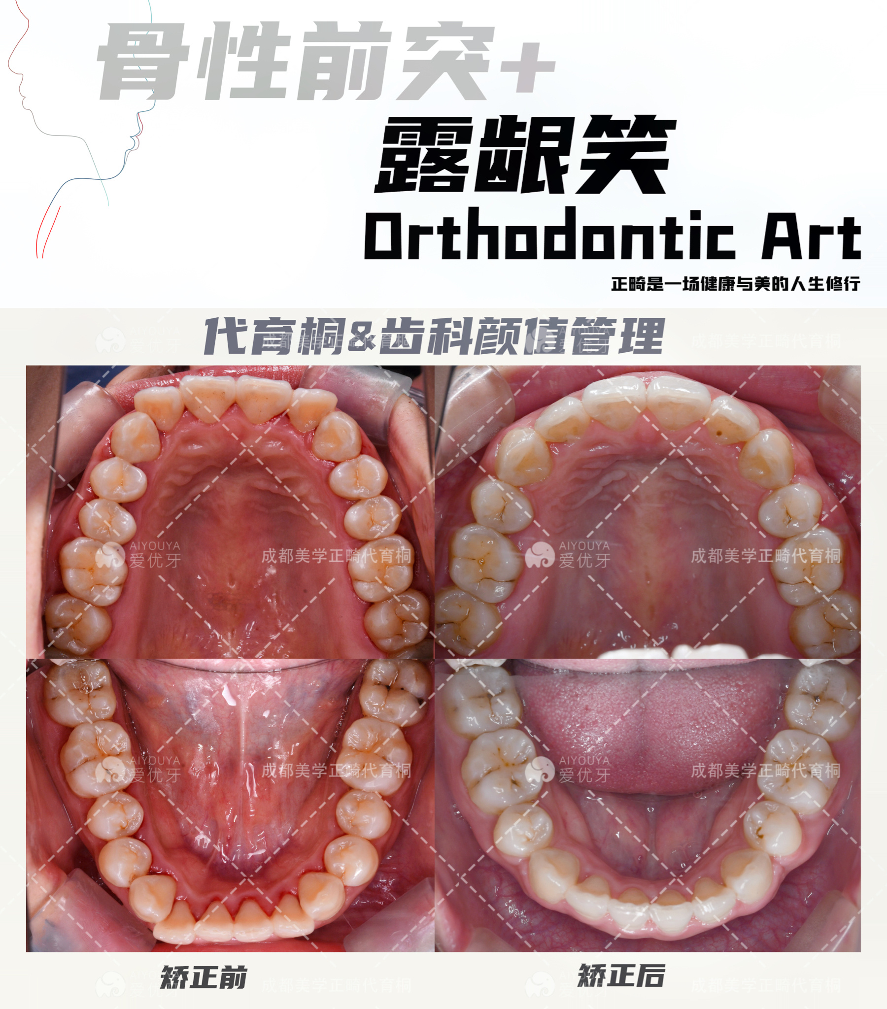 使用隱適美牙套,拔除四顆雙尖牙矯正;考慮到姑娘面型的協調性,對牙齒