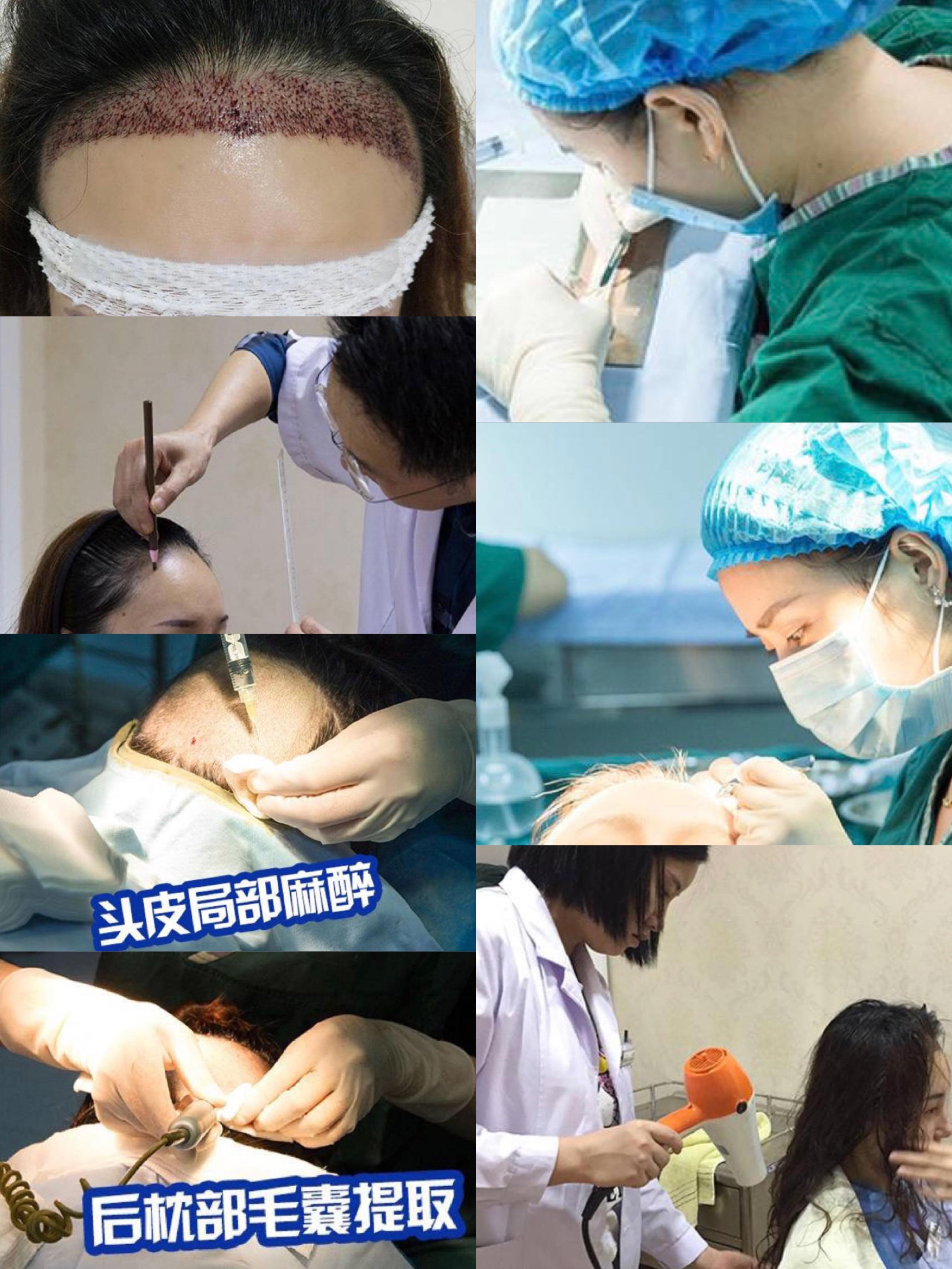 植发的总费用=移植毛囊的数量*每个毛囊的价格 麻醉费 术后开的药钱