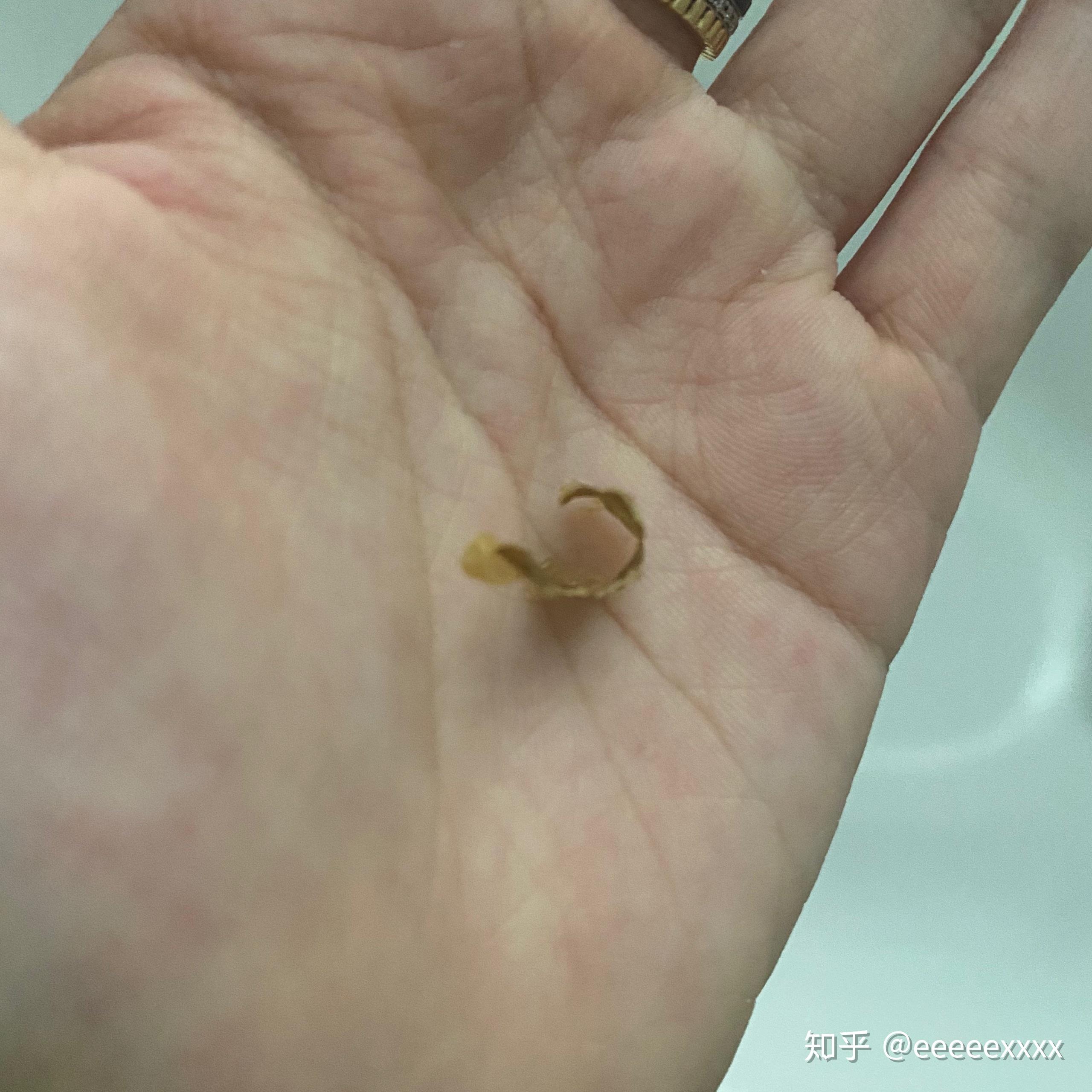 耳屎能大到什么程度