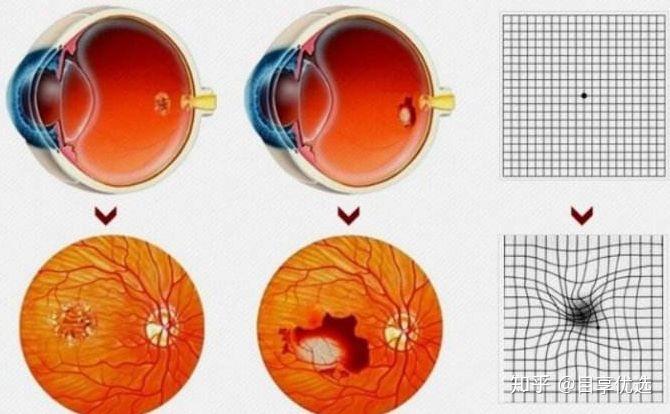 视野缺损图解图片