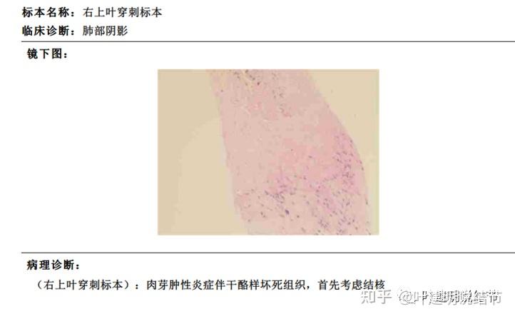 肺結節的穿刺到底是否需要如何辯證看待這一問題之我見