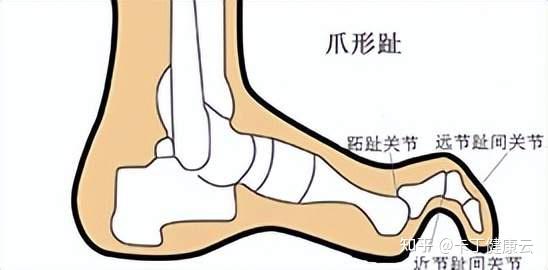 为什么别人的脚趾是直的,而自己的脚趾是弯的?爪形趾了解一下! - 知乎