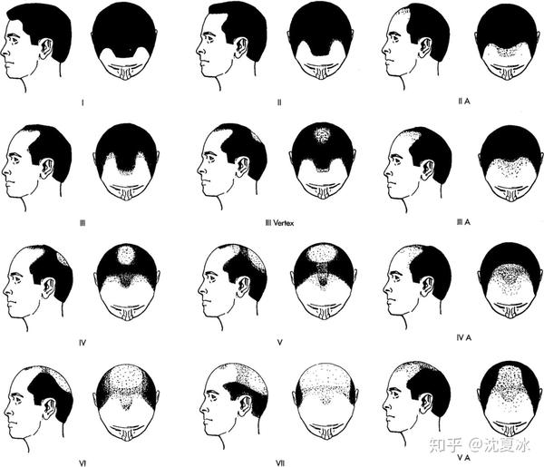判断,雄性脱发的特点是由前额发际线的衰退和头发覆盖在垂直头皮变薄
