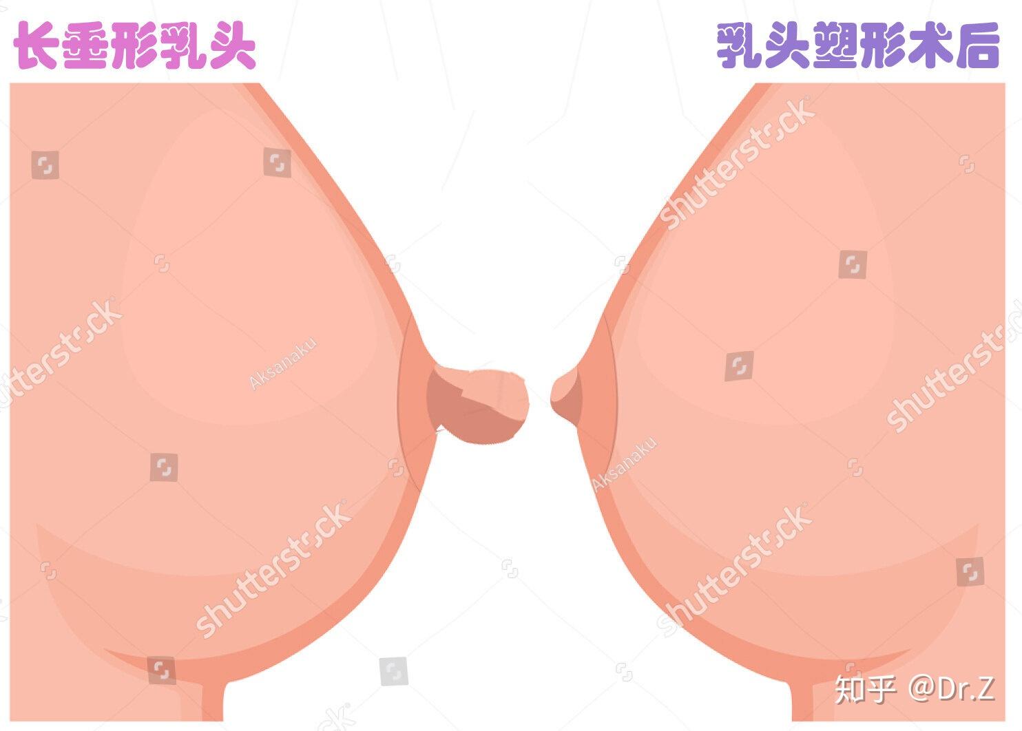 乳房乳头肥大图片