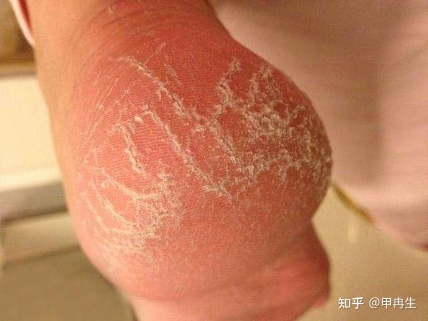 脚后跟粗糙易干裂 小腿上起皮屑是什么原因 知乎
