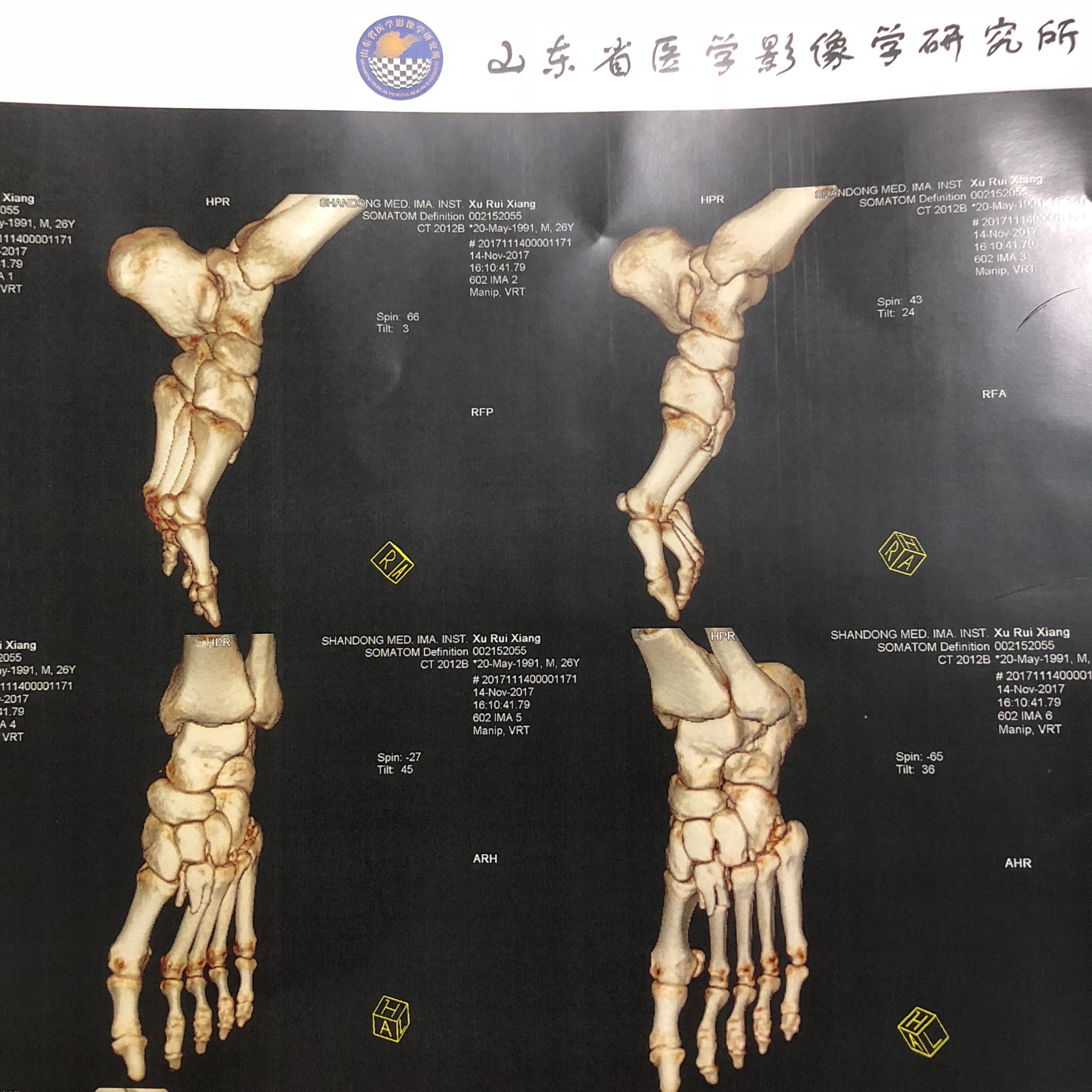 左腳第二蹠骨骨折需要多久才能正常走路